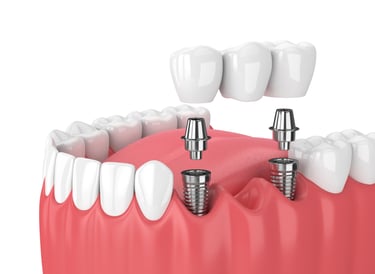 dental implant near you