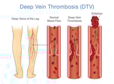 vascular ultrasound blood clot deep vein thrombosis leg swelling thinner anticoagulant embolism pain doppler factor v leiden