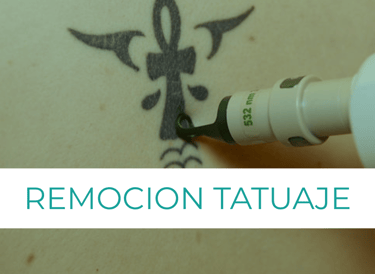 remocion laser de tatuajes