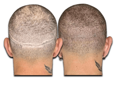 a before/after photo of a man who has received an SMP treatment on his scalp