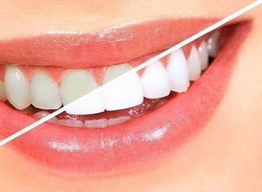 تبييض الأسنان في الكويت