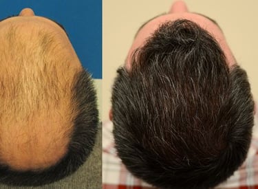 Best Hair transplant surgery FUE Surgery & PRP Therapy & GFC PRP in Udaipur.