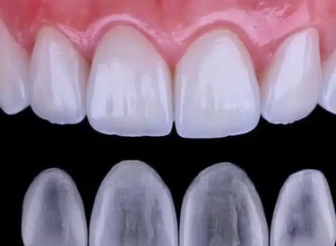 Sorriso bonito com facetas aplicadas por dentista na Lapa PR.