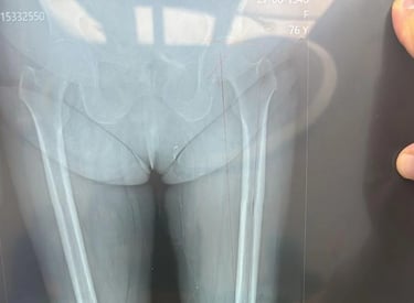 radiografía de cadera