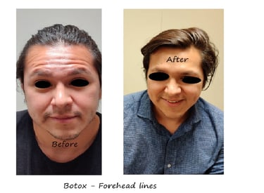 Före- och efterbild av botox i pannan - minskade rynkor och naturlig ögonbrynsform.