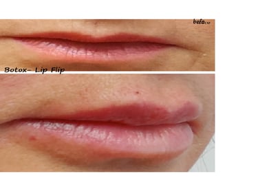 Before and after image of botox lip flip – fuller lips and reduced lines around the mouth.