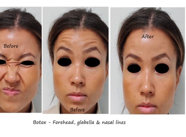 Före- och efterbild botox panna, näsa & glabella – jämnare överansikte och yngre utseende.