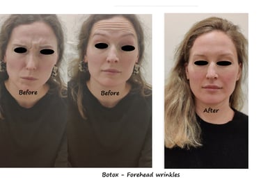 Botoxbehandling i panna och glabella – före- och efterbild som visar reducerade rynkor.