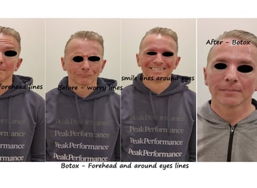 Före- och efterbild av botox i panna, glabella och runt ögonen: borttagning av horisontella linjer,