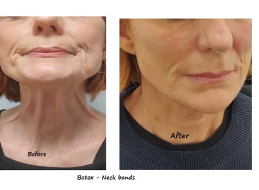 Före- och efterbild av botox i hals med reducerade nackband och ett mer ungdomligt utseende.