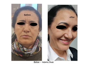 Före- & efterbild botox bekymmersrynkor – slätare glabella & avslappnat uttryck.