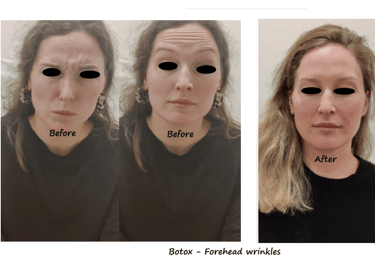 Botox treatment in the forehead and glabella – before and after photos showing reduced wrinkles.