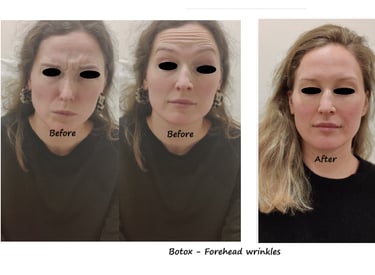 Botoxbehandling i panna och glabella – före- och efterbild som visar reducerade rynkor