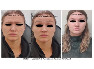 Botox panna & glabella före- och efterbild – slätare panna och ungdomligt utseende.