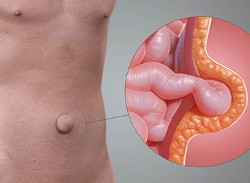 Imagem ilustrativa Hérnia Umbilical