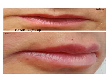 Före- och efterbild av botox lip flip – fylligare läppar och minskade linjer runt munnen.