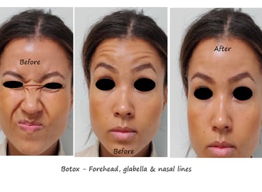 Före- och efterbild botox panna, näsa & glabella – jämnare överansikte och yngre utseende.