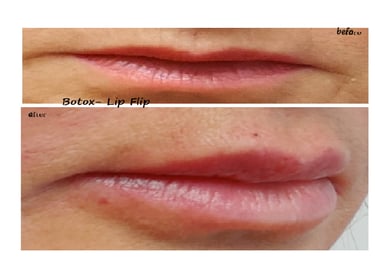 Före- och efterbild av botox lip flip – fylligare läppar och minskade linjer runt munnen.