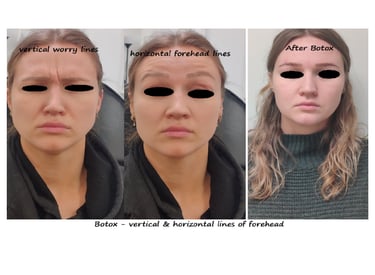 Botox panna & glabella före- och efterbild – slätare panna och ungdomligt utseende.