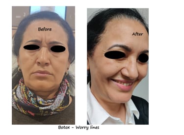 Före- & efterbild botox bekymmersrynkor – slätare glabella & avslappnat uttryck.