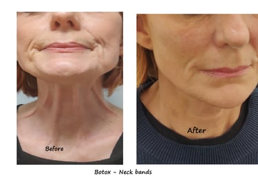 Före- och efterbild av botox i hals – reducerade nackband och ett mer ungdomligt utseende.