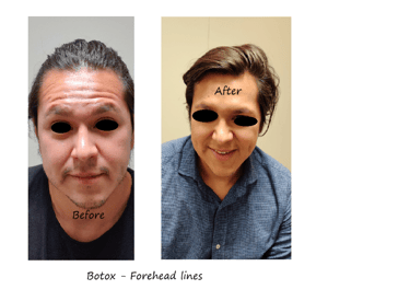 Before and after photos of botox in the forehead - reduced wrinkles and natural eyebrow shape.