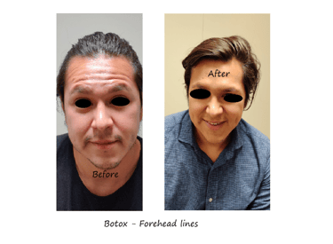 Before and after photos of botox in the forehead - reduced wrinkles and natural eyebrow shape.