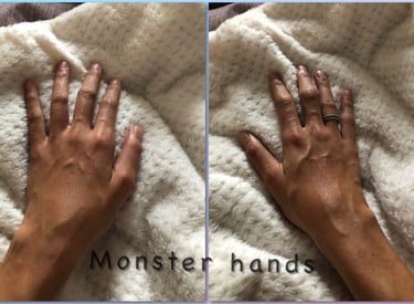 rheumatoid arthiritis hands