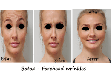 Botox in forehead and glabella before and after photo – reduced wrinkles and youthful appearance.