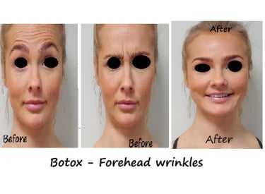 Botox i panna och glabella före- och efterbild – reducerade rynkor och ungdomligt utseende.