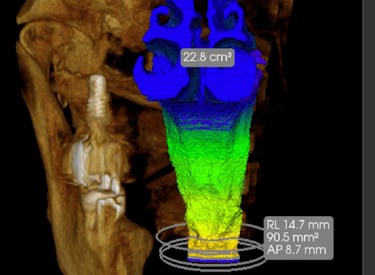 tomografia vias aéreas