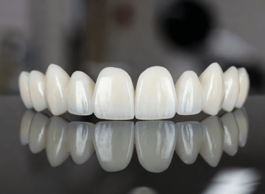 carillas dentales en las palmas de gran canaria