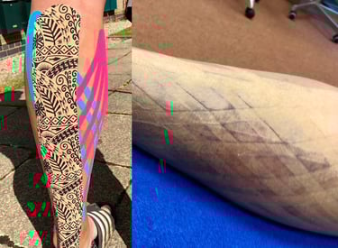 Kinesio taping of a calf tear showing the lymphatic drainage effect