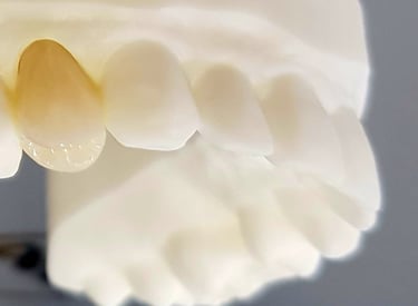 Moldura de dentes ilustrando implantes dentários realizados por dentista na Lapa PR.