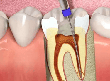 علاج عصب الأسنان