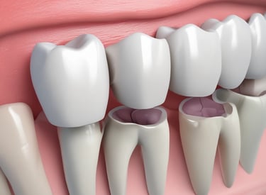 Dental Crowns & Bridges Greater Noida