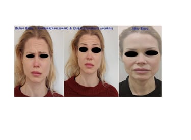 Före- och efterbild botox panna & glabella – reducerade rynkor & jämnare utseende