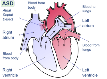Arterial Septal Defect