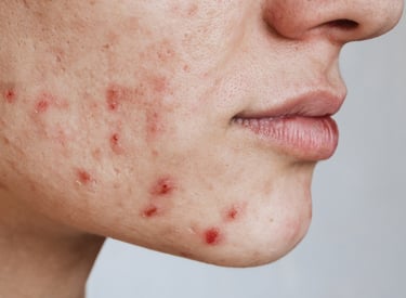 peeling acne le mans