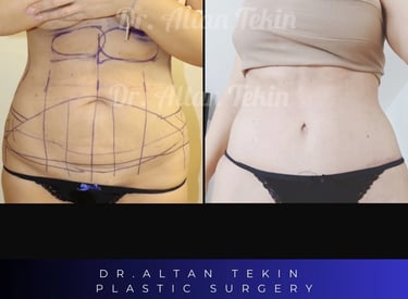 body lift before after photos, Antalya