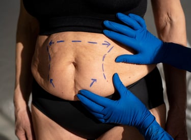 tummy tuck is a cosmetic surgery procedure used to make the abdomen thinner and more firm.