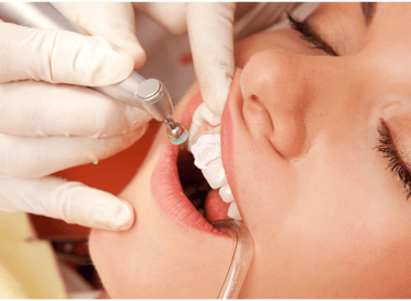 Dental bonding near me | Ekdantam Dental Clinic Navi Mumbai