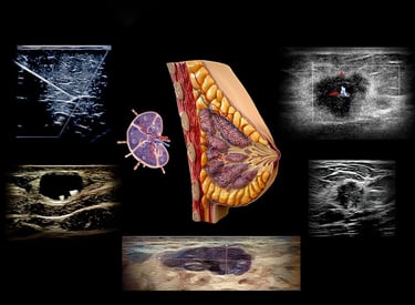 Breast anatomy diagram and various breast ultrasound images shoeing pathology.