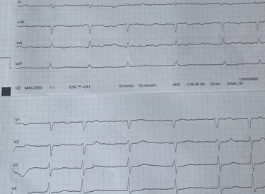 EKG