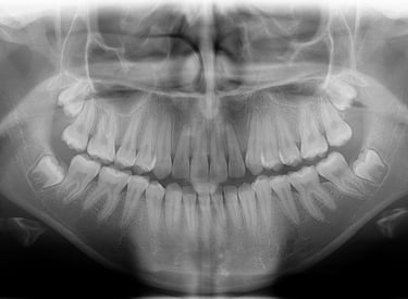 extraccion de cordales dolor cordal
