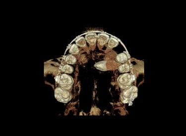 extraccion dientes complejos dificiles cirujano