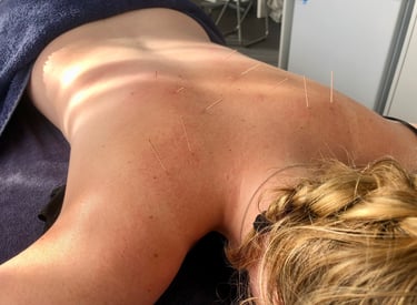 A woman is lying on her front with acupuncture needles in her shoulders and back