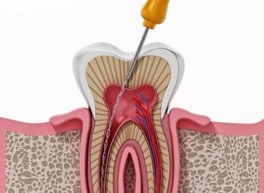 Cross-section medical illustration of a root canal procedure on a human molar tooth.