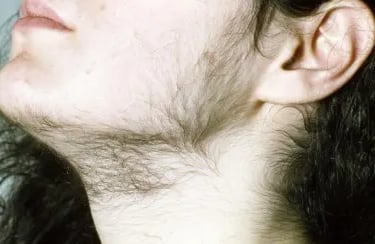 Best Hirsutism treatment in Madinaguda & KPHB, Hyderabad by Dr. Shalini Patlolla