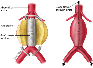 open surgical aortic aneurysm repair